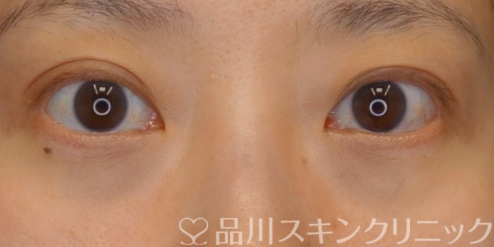 症例NO.74081のAFTER写真