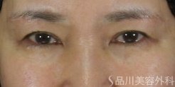 症例NO.74106のAFTER写真