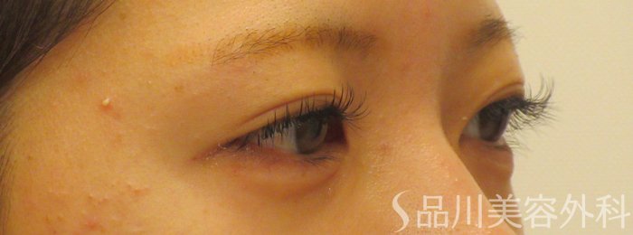 症例NO.72017のAFTER写真