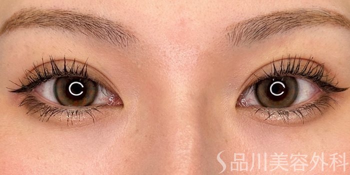 症例NO.73621のAFTER写真