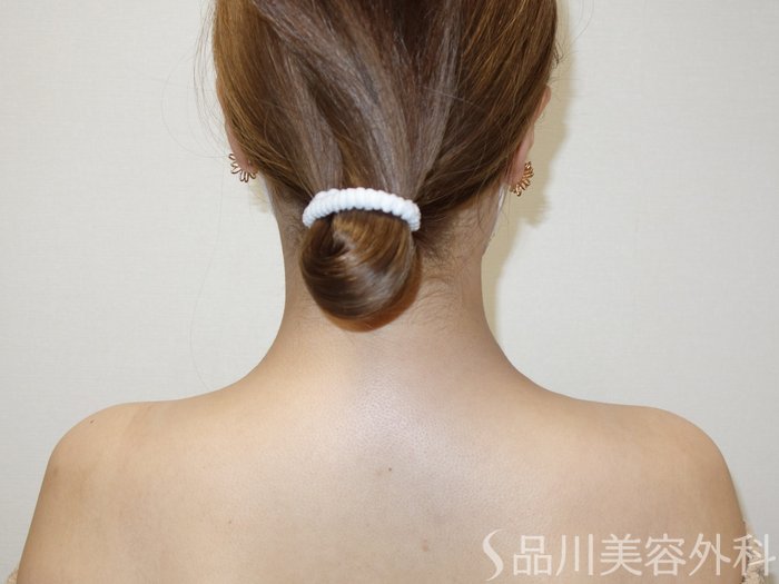 症例NO.73548のAFTER写真