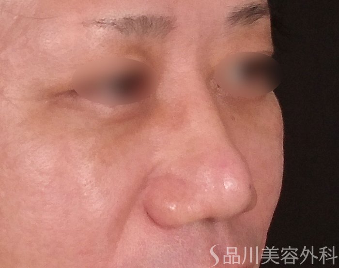 症例NO.70255のBEFORE写真