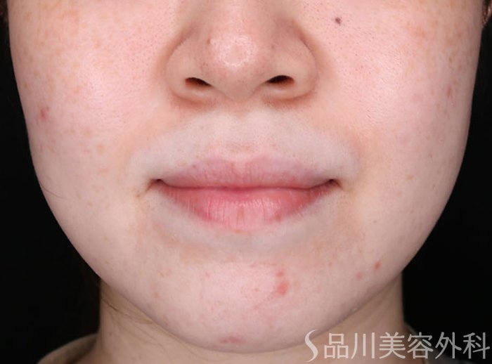 症例NO.72310のBEFORE写真