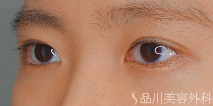症例NO.70523のAFTER写真