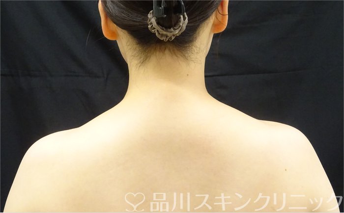 症例NO.72653のAFTER写真