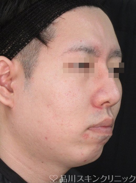 症例NO.72307のBEFORE写真