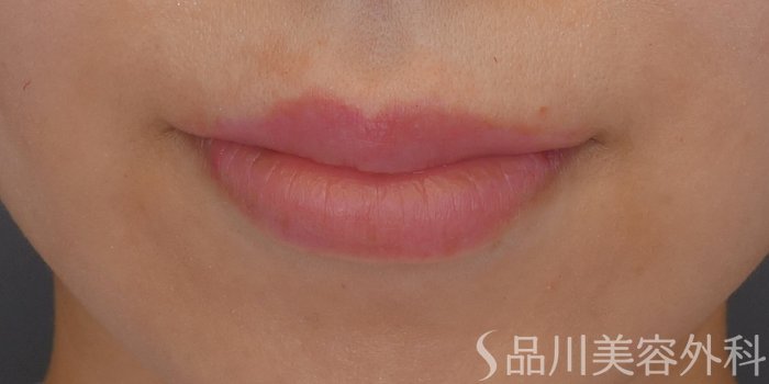 症例NO.71350のAFTER写真