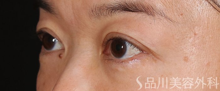 症例NO.73670のBEFORE写真