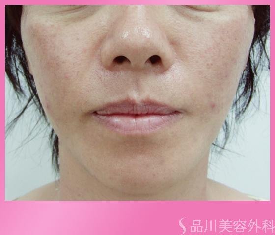 症例NO.1152のAFTER写真