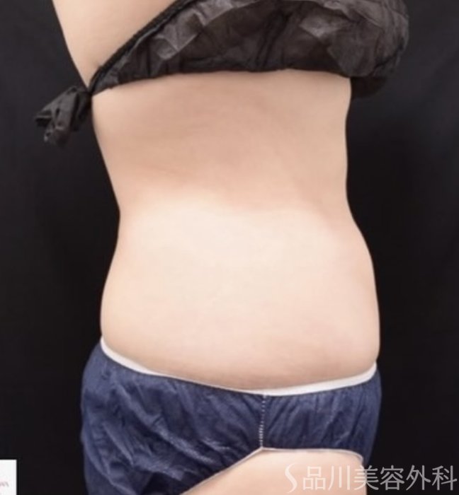 症例NO.68574のAFTER写真
