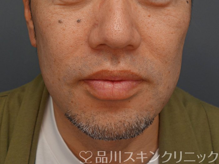 症例NO.74257のBEFORE写真