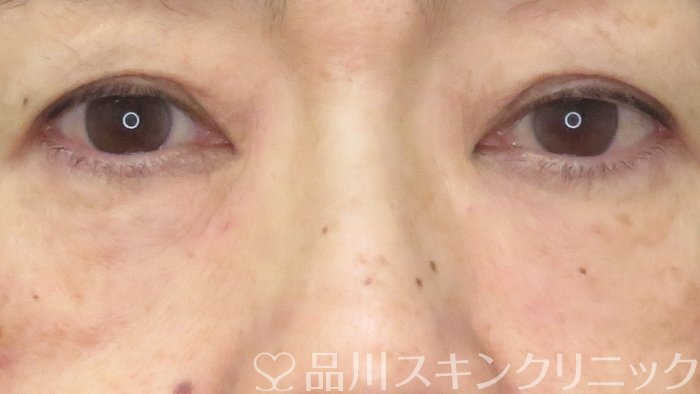 症例NO.71222のAFTER写真