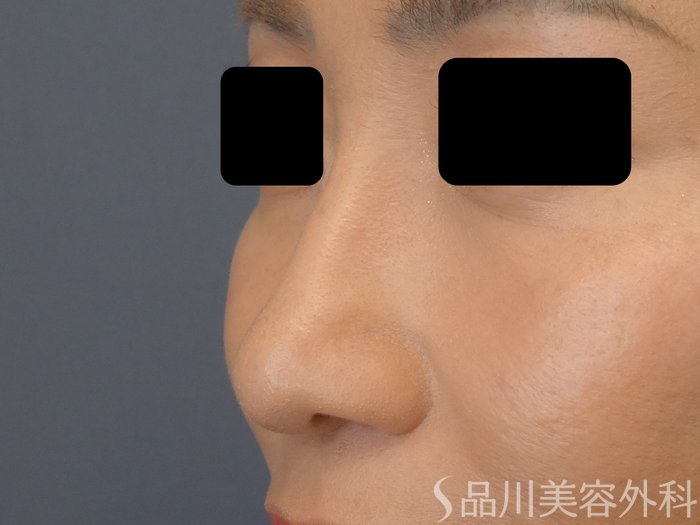 症例NO.69357のBEFORE写真