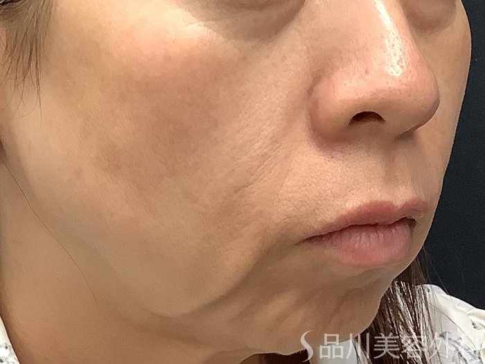 症例NO.67843のBEFORE写真
