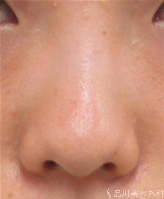 症例NO.22125のBEFORE写真