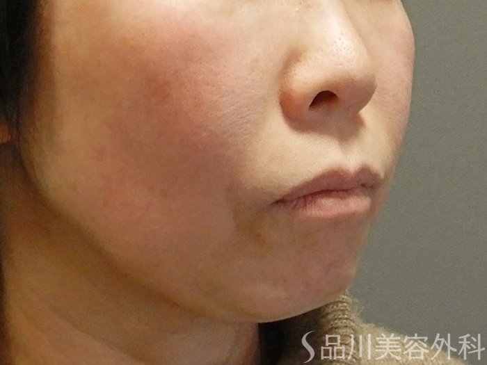 症例NO.69536のBEFORE写真