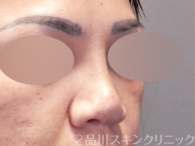 症例NO.67917のBEFORE写真