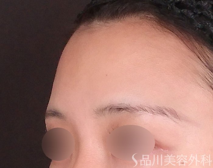 症例NO.70695のBEFORE写真