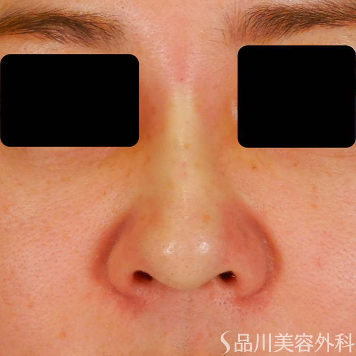 症例NO.69310のAFTER写真