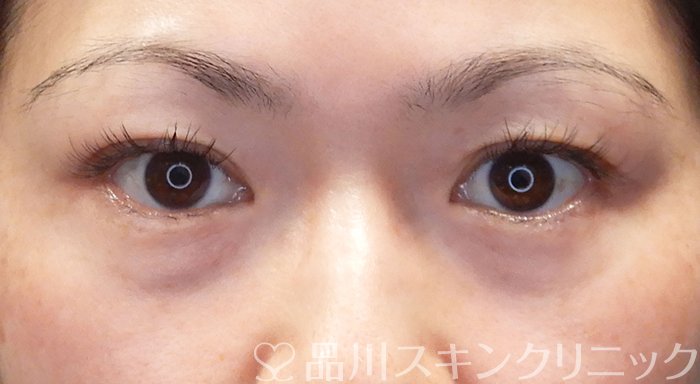 症例NO.69558のBEFORE写真