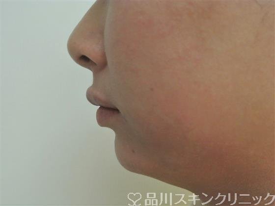 症例NO.45540のAFTER写真