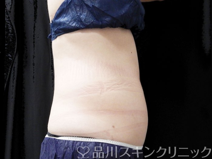症例NO.74706のBEFORE写真
