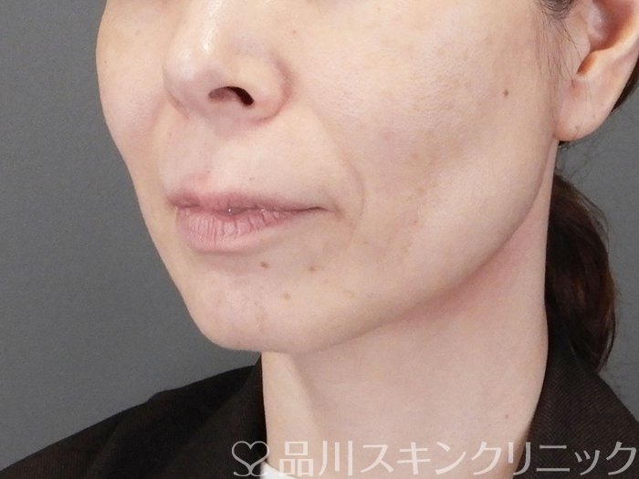 症例NO.75271のBEFORE写真