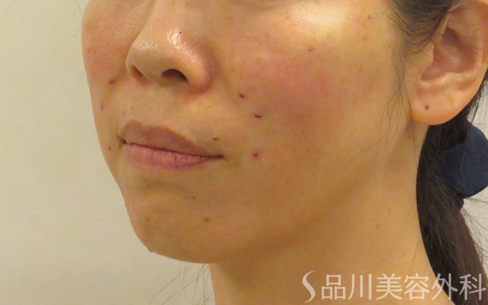 症例NO.72101のAFTER写真