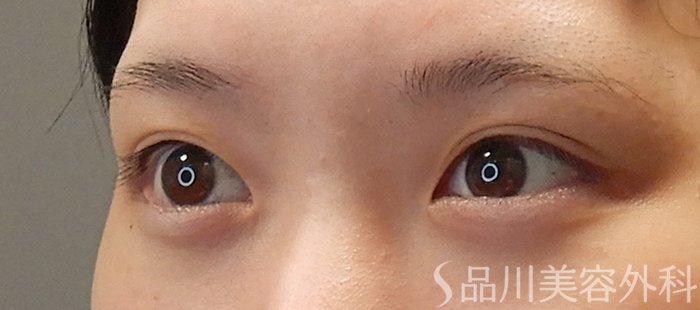 症例NO.71668のBEFORE写真