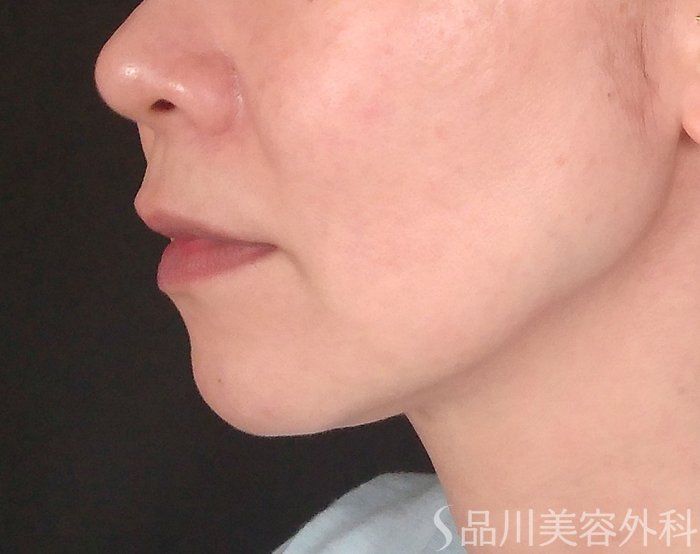 症例NO.70393のBEFORE写真