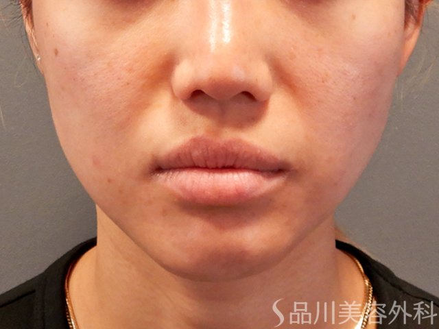 症例NO.70029のBEFORE写真