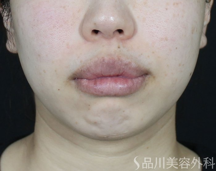 症例NO.65663のBEFORE写真