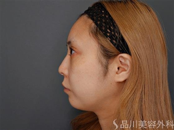 症例NO.60887のBEFORE写真