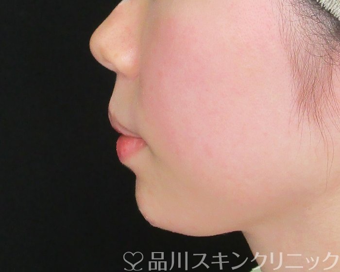 症例NO.69740のAFTER写真