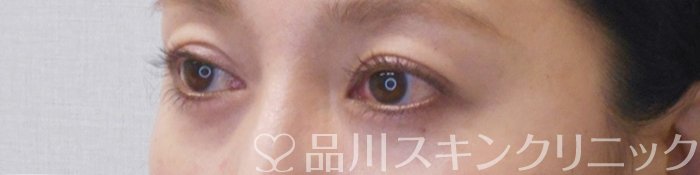 症例NO.71091のAFTER写真