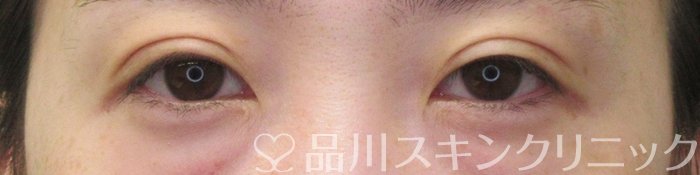 症例NO.74517のAFTER写真