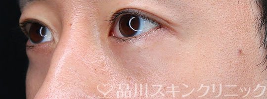 症例NO.74019のAFTER写真