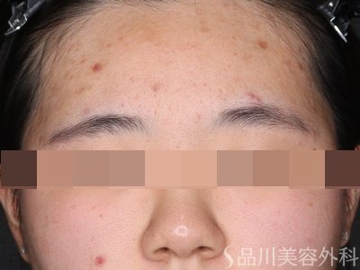 症例NO.75116のBEFORE写真