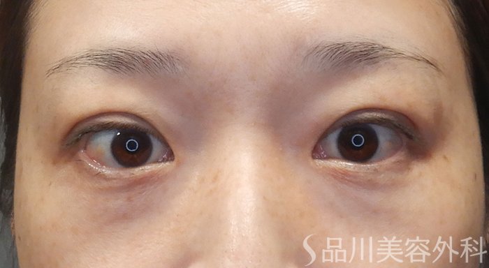 症例NO.72003のAFTER写真