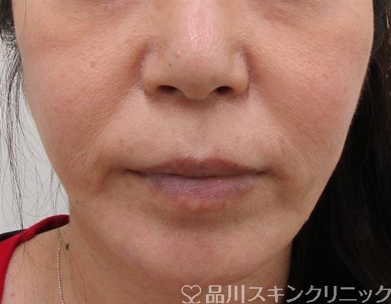 症例NO.36443のBEFORE写真