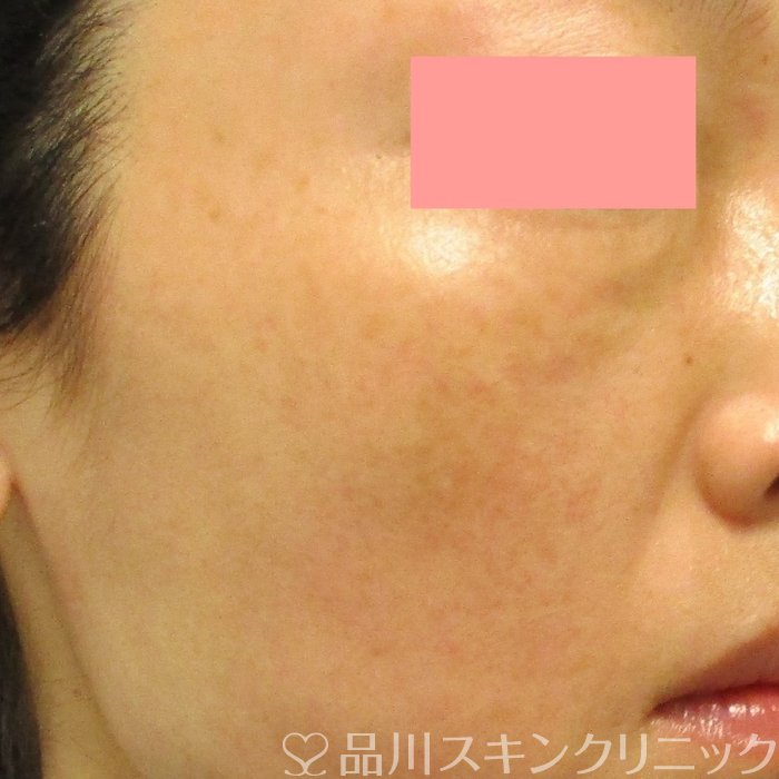 症例NO.70998のAFTER写真