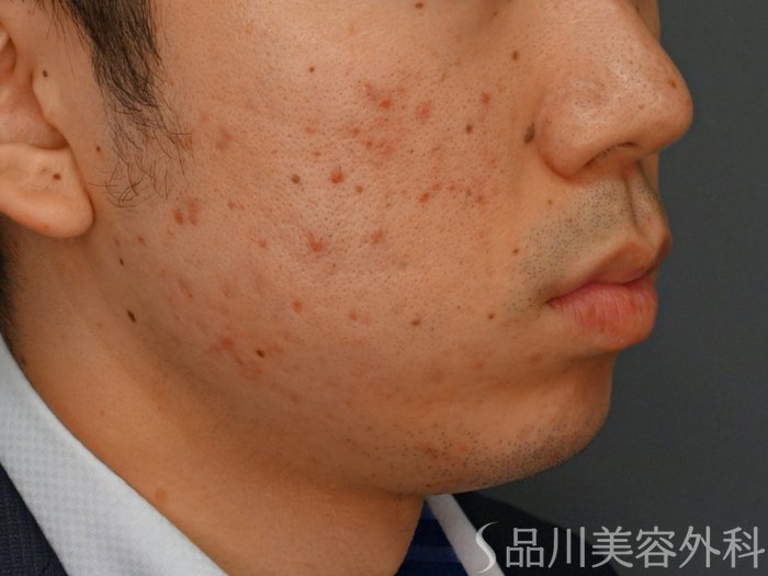 症例NO.75252のBEFORE写真