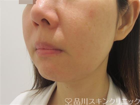 症例NO.44896のAFTER写真