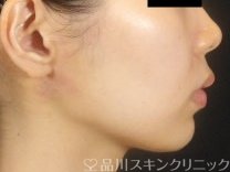 症例NO.74305のBEFORE写真