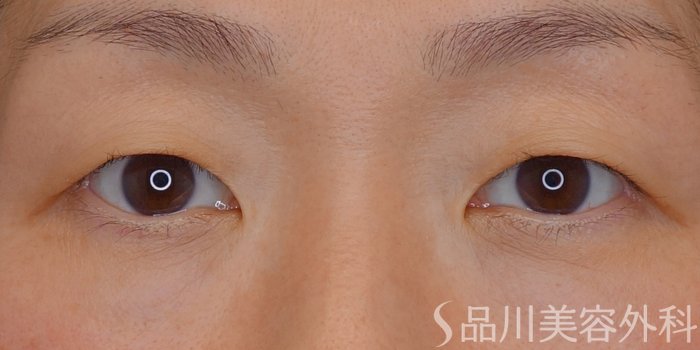 症例NO.73988のBEFORE写真