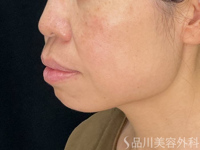 症例NO.71936のBEFORE写真