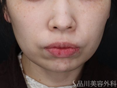 症例NO.73724のBEFORE写真