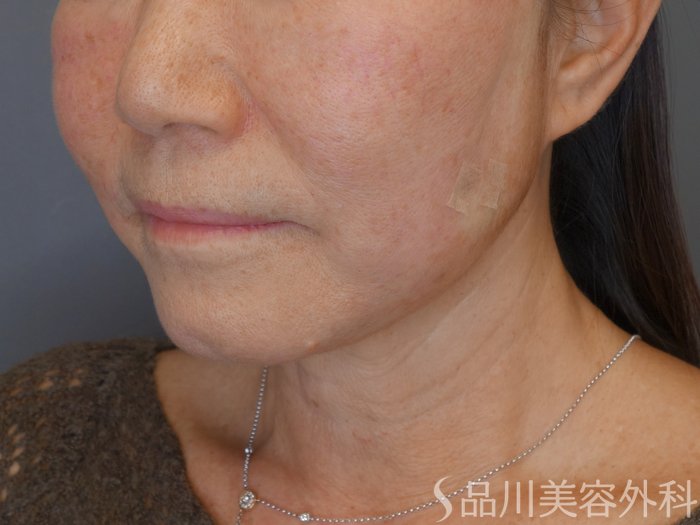 症例NO.72365のAFTER写真