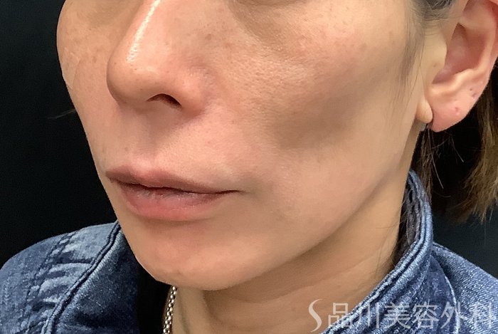 症例NO.69485のBEFORE写真