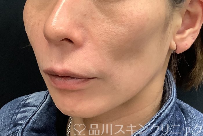 症例NO.69485のBEFORE写真